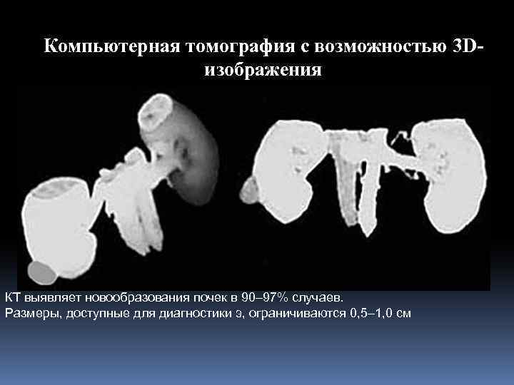 Компьютерная томография с возможностью 3 Dизображения КТ выявляет новообразования почек в 90– 97% случаев.