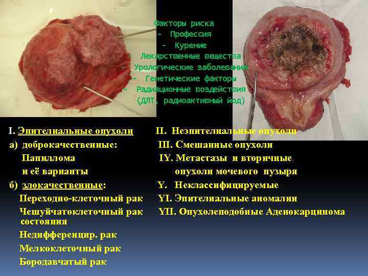 Факторы риска - Профессия - Курение - Лекарственные вещества - Урологические заболевания - Генетические