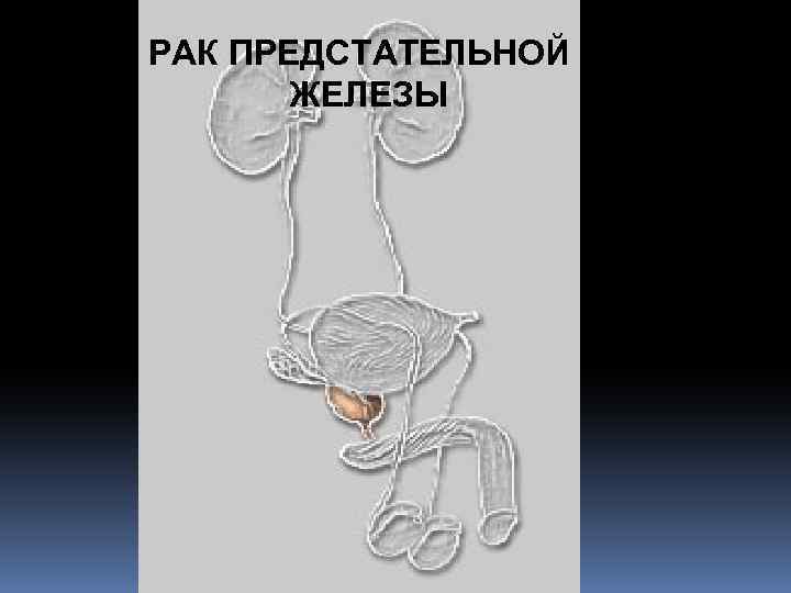 РАК ПРЕДСТАТЕЛЬНОЙ ЖЕЛЕЗЫ 