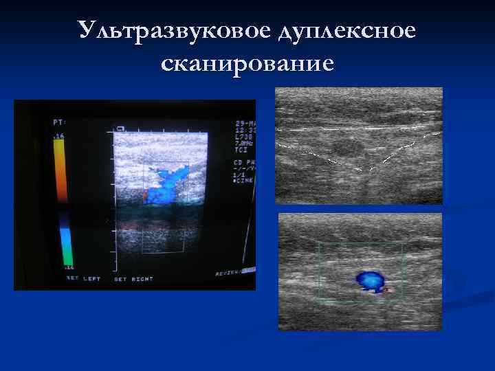 Ультразвуковое дуплексное сканирование 