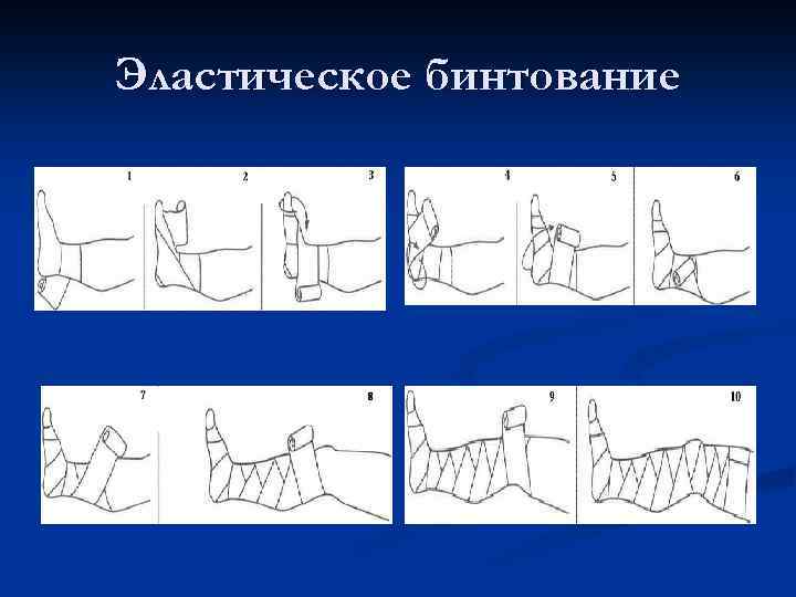 Эластическое бинтование 