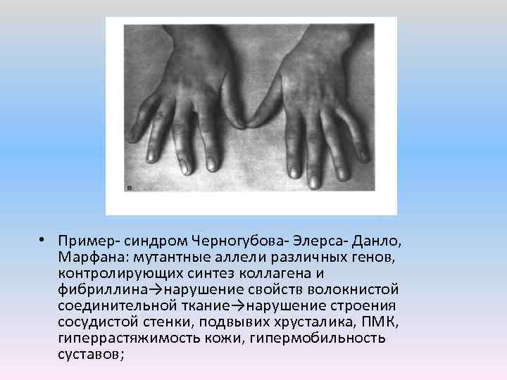  • Пример синдром Черногубова Элерса Данло, Марфана: мутантные аллели различных генов, контролирующих синтез