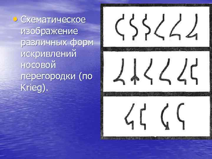  • Схематическое изображение различных форм искривлений носовой перегородки (по Krieg). 