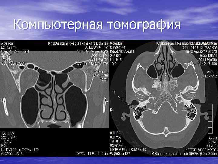 Компьютерная томография 