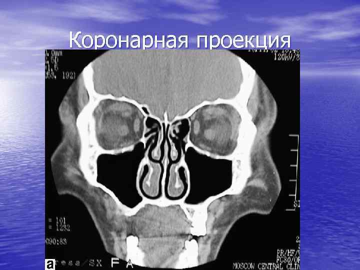 Коронарная проекция 