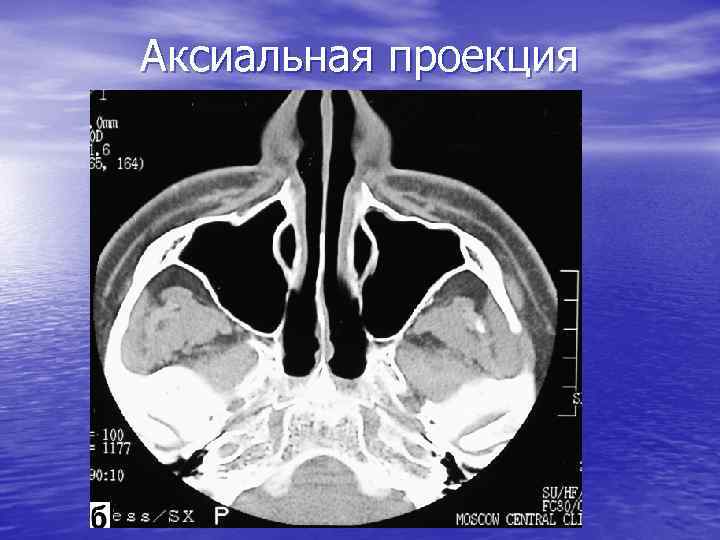 Аксиальная проекция 