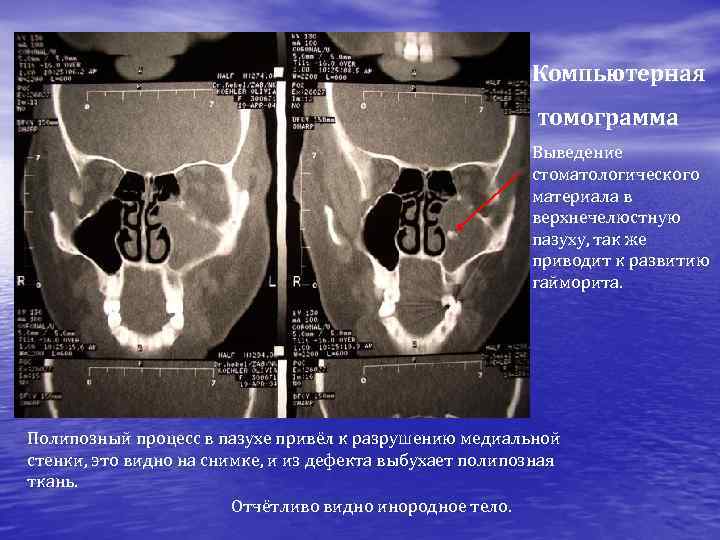 Компьютерная томограмма Выведение стоматологического материала в верхнечелюстную пазуху, так же приводит к развитию гайморита.