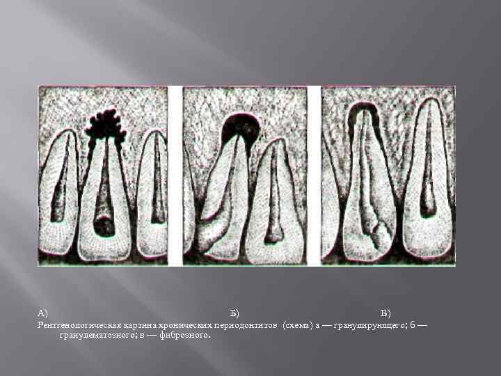 А) Б) В) Рентгенологическая картина хронических периодонтитов (схема) а — гранулирующего; б — гранулематозного;