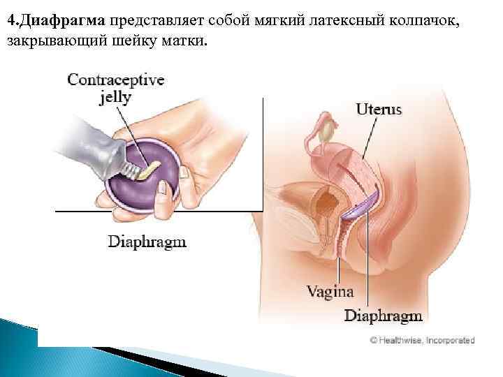 4. Диафрагма представляет собой мягкий латексный колпачок, закрывающий шейку матки. 