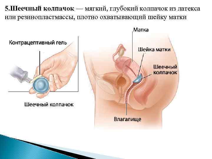 5. Шеечный колпачок — мягкий, глубокий колпачок из латекса или резинопластмассы, плотно охватывающий шейку