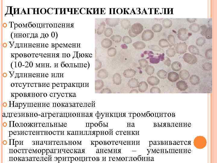 Тромбоцитопения 1. Тромбоцитопения Верльгофа. Тромбоцитопения картина крови. Картина крови при болезни Верльгофа. Заболевания нарушения тромбоцитов.