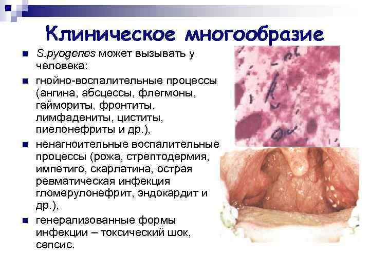 Клиническое многообразие n n S. pyogenes может вызывать у человека: гнойно-воспалительные процессы (ангина, абсцессы,