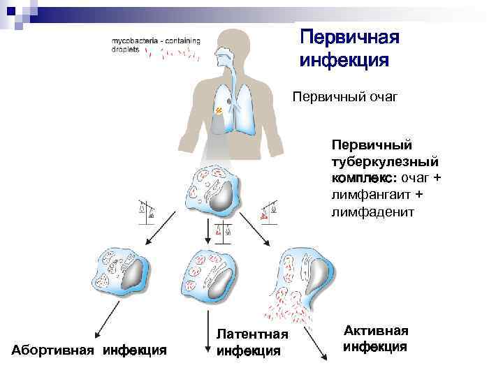 Первичная инфекция Первичный очаг Первичный туберкулезный комплекс: очаг + лимфангаит + лимфаденит Абортивная инфекция