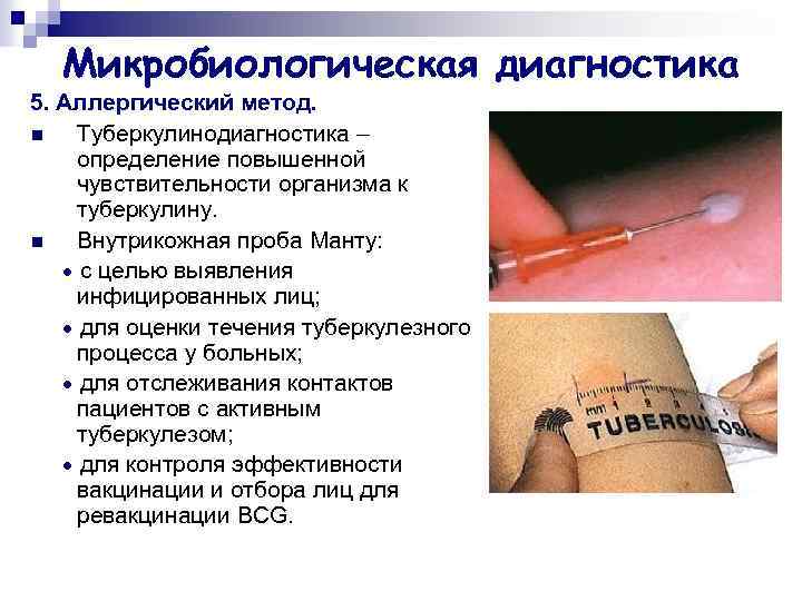 Микробиологическая диагностика 5. Аллергический метод. n Туберкулинодиагностика – определение повышенной чувствительности организма к туберкулину.