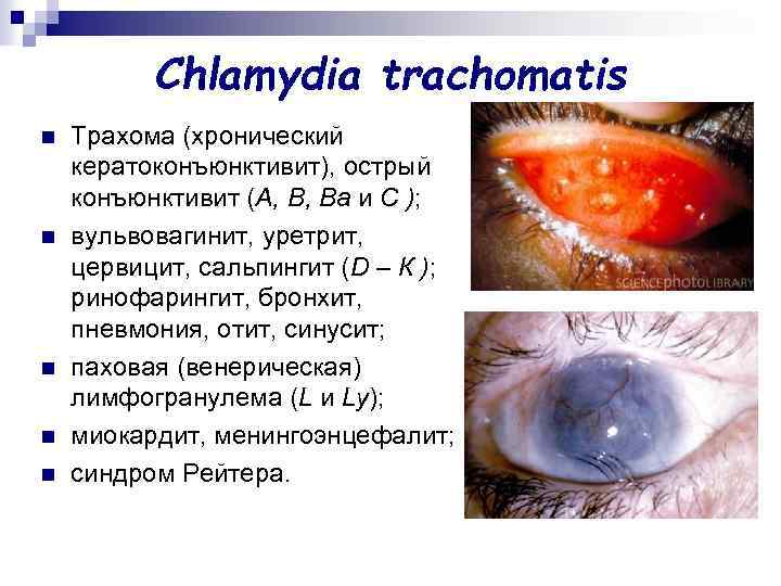 Chlamydia trachomatis n n n Трахома (хронический кератоконъюнктивит), острый конъюнктивит (А, В, Ва и