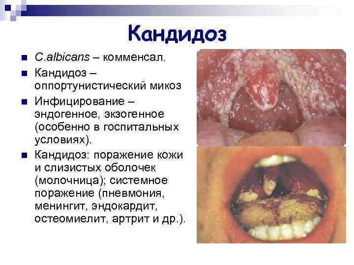 Кандидоз n n C. albicans – комменсал. Кандидоз – оппортунистический микоз Инфицирование – эндогенное,