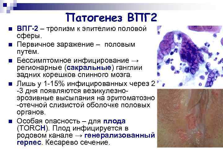 Патогенез ВПГ 2 n n n ВПГ-2 – тропизм к эпителию половой сферы. Первичное