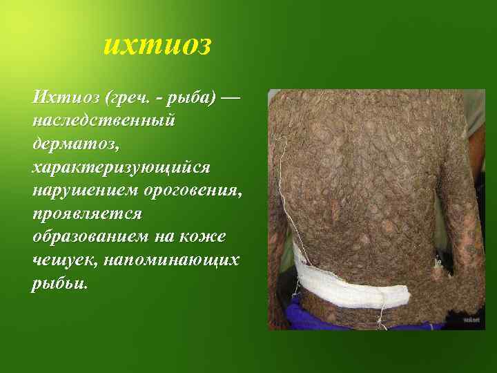 ихтиоз Ихтиоз (греч. - рыба) — наследственный дерматоз, характеризующийся нарушением ороговения, проявляется образованием на