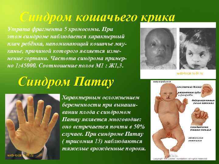 Синдром кошачьего крика Утрата фрагмента 5 хромосомы. При этом синдроме наблюдается характерный плач ребёнка,