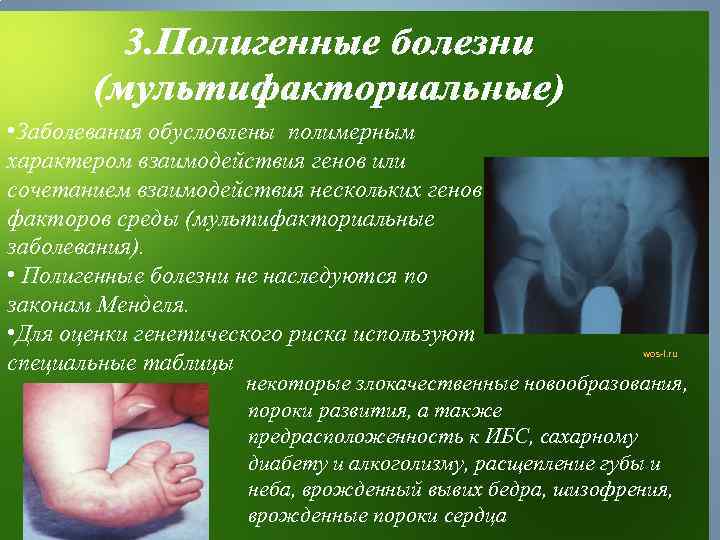  • Заболевания обусловлены полимерным характером взаимодействия генов или сочетанием взаимодействия нескольких генов и