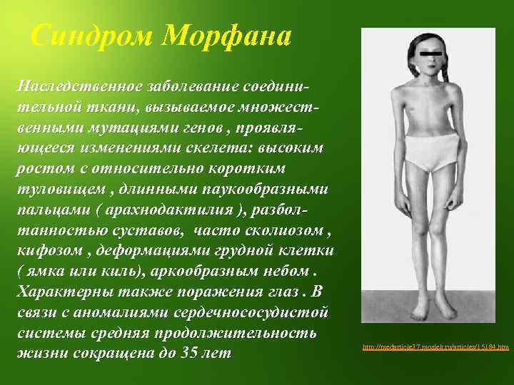 Синдром Морфана Наследственное заболевание соединительной ткани, вызываемое множественными мутациями генов , проявляющееся изменениями скелета: