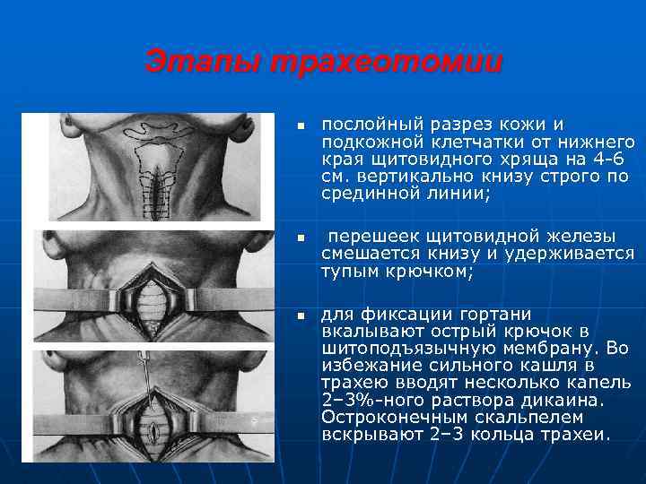 Этапы трахеотомии n n n послойный разрез кожи и подкожной клетчатки от нижнего края