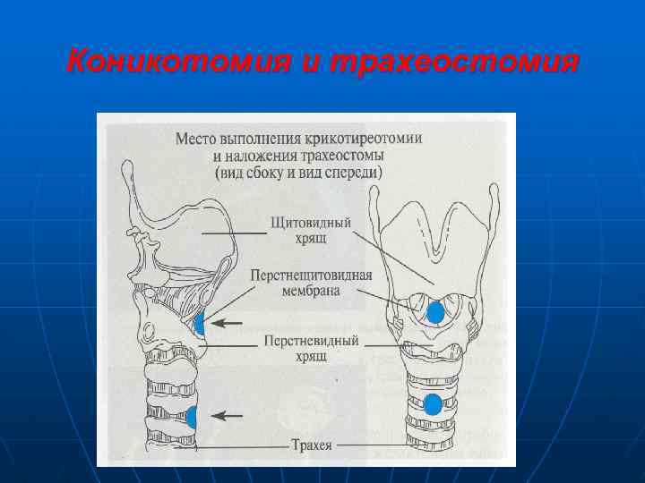 Коникотомия и трахеостомия 