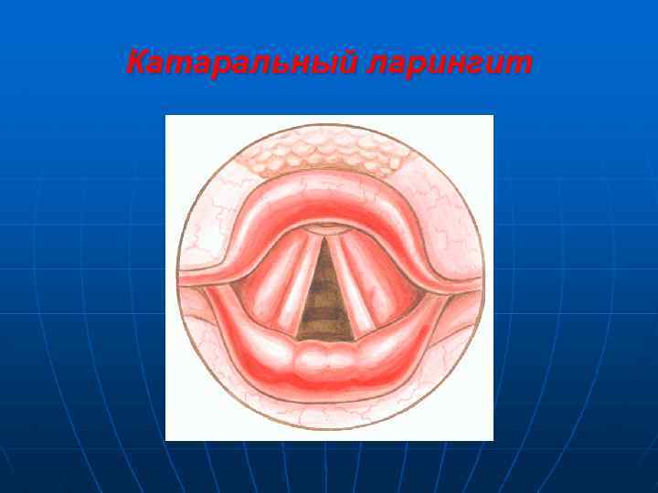 Катаральный ларингит 