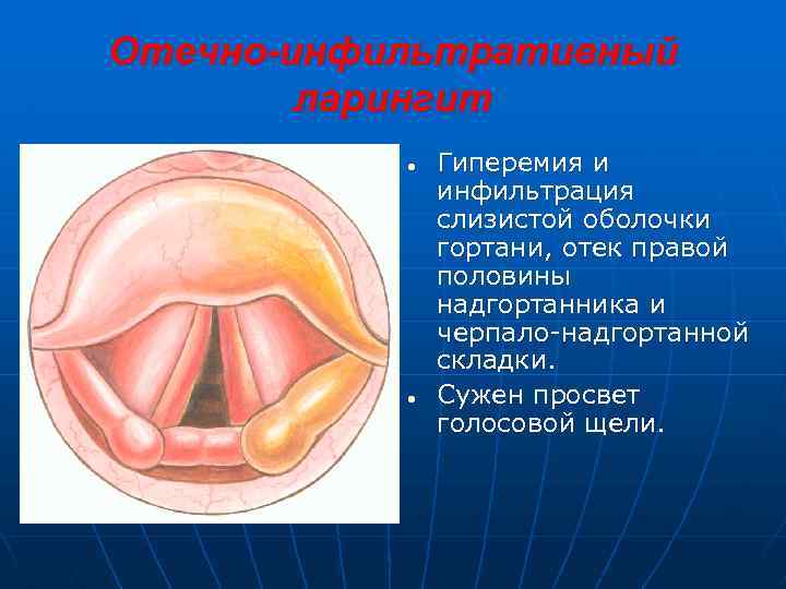 Отечно-инфильтративный ларингит ● ● Гиперемия и инфильтрация слизистой оболочки гортани, отек правой половины надгортанника