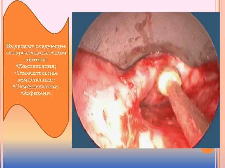 Выделяют следующие четыре стадии стеноза гортани: • Компенсация; • Относительная компенсация; • Декомпенсация; •