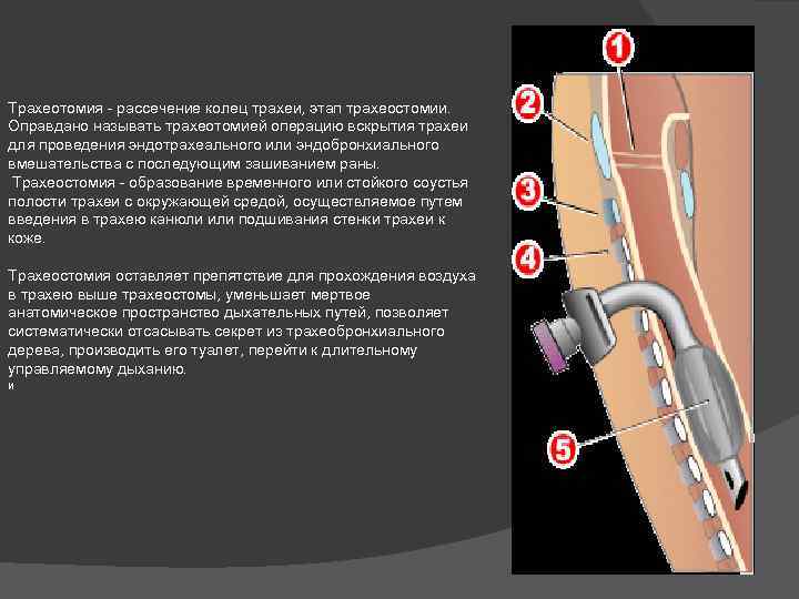 Трахеотомия - рассечение колец трахеи, этап трахеостомии. Оправдано называть трахеотомией операцию вскрытия трахеи для