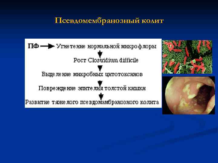 Псевдомембранозный колит 