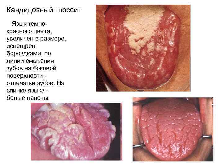 Кандидозный глоссит Язык темнокрасного цвета, увеличен в размере, испещрен бороздками, по линии смыкания зубов