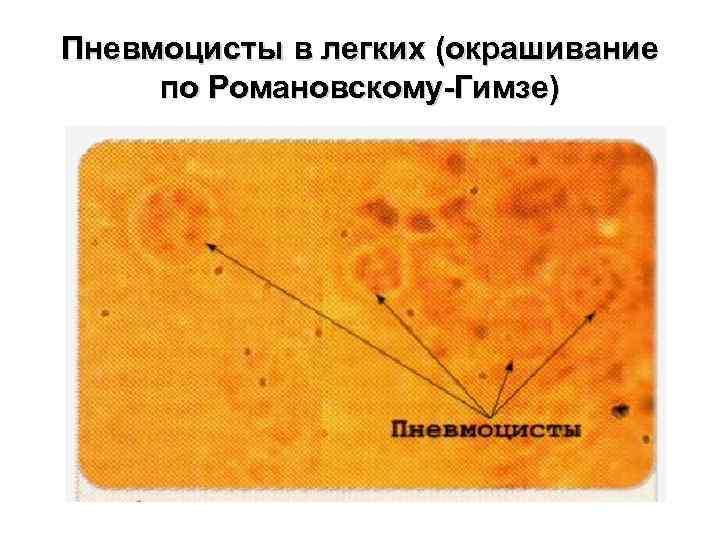 Пневмоцисты в легких (окрашивание по Романовскому-Гимзе) 