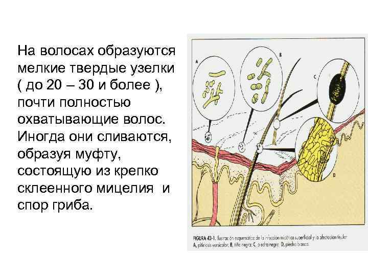 На волосах образуются мелкие твердые узелки ( до 20 – 30 и более ),