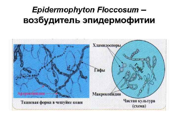 Epidermophyton Floccosum – возбудитель эпидермофитии 