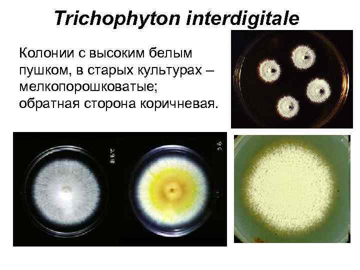 Trichophyton interdigitale Колонии с высоким белым пушком, в старых культурах – мелкопорошковатые; обратная сторона