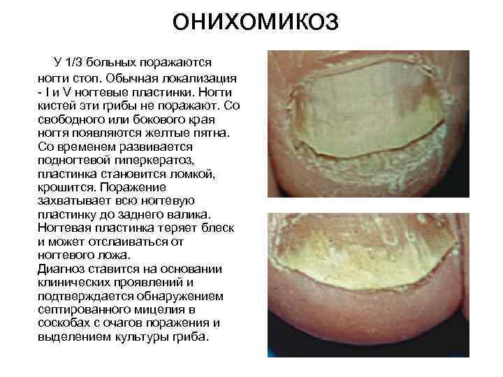 онихомикоз У 1/3 больных поражаются ногти стоп. Обычная локализация - I и V ногтевые