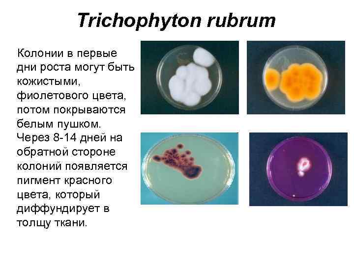 Trichophyton rubrum Колонии в первые дни роста могут быть кожистыми, фиолетового цвета, потом покрываются