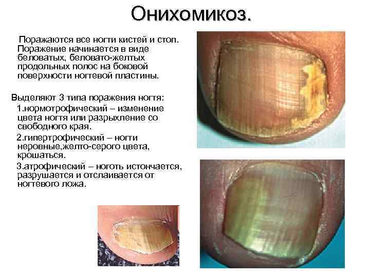 Онихомикоз. Поражаются все ногти кистей и стоп. Поражение начинается в виде беловатых, беловато-желтых продольных