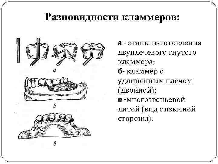 Разновидности кламмеров: а - этапы изготовления двуплечевого гнутого кламмера; б- кламмер с удлиненным плечом
