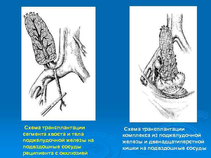 Схема трансплантации сегмента хвоста и тела поджелудочной железы на подвздошные сосуды реципиента с окклюзией