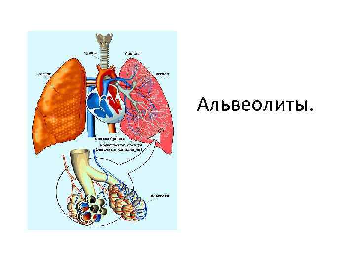 Альвеолиты у детей презентация