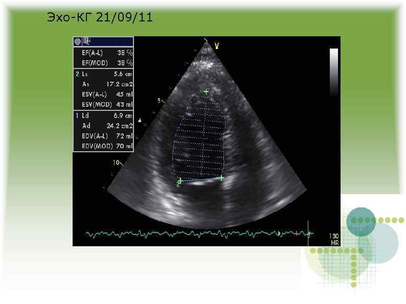 Эхо-КГ 21/09/11 