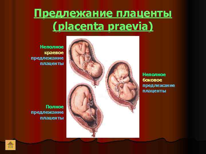 Предлежание плаценты (placenta praevia) Неполное краевое предлежание плаценты Неполное боковое предлежание плаценты Полное предлежание