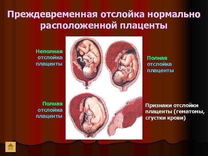 Преждевременная отслойка нормально расположенной плаценты Неполная отслойка плаценты Полная отслойка плаценты Признаки отслойки плаценты