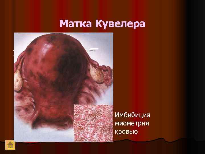 Матка Кувелера 1 Имбибиция миометрия кровью 