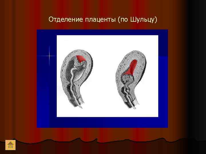 Отделение плаценты (по Шульцу) 