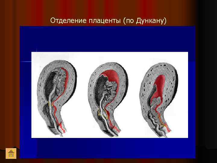 Отделение плаценты (по Дункану) 