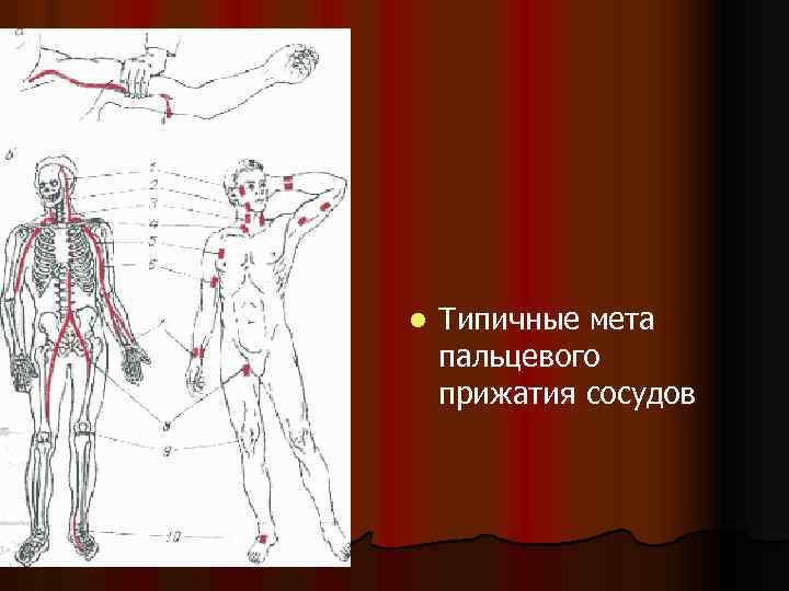 Признак эффективности пальцевого прижатия артерии